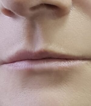 Woman concerned about thin lips