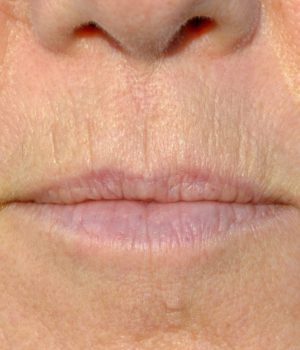 Woman with above lip line concerns