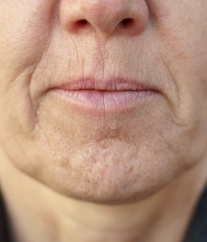 Woman with marionette line concerns