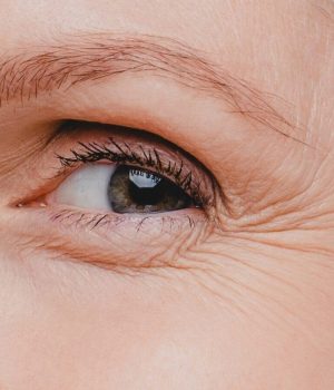 Woman with crows feet concerns