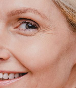 Woman with crows feet concerns