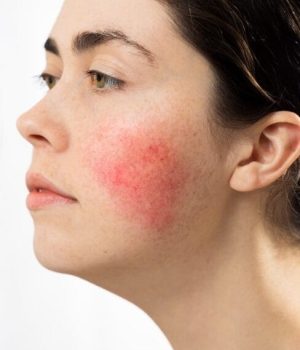 Woman with concerns of broken capillaries on the face