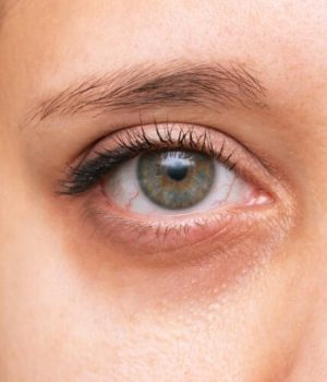 Woman with tear trough and dark eye circle concerns