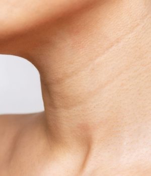 Woman with neck line concerns
