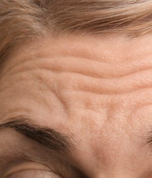 Woman with strong forehead wrinkles