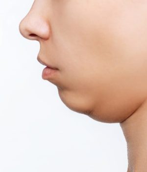 Woman with double chin concerns