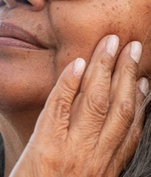 Woman with concerns of hyperpigmentation of the face