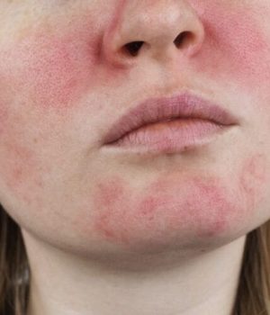 Young girl with concerns of facial redness