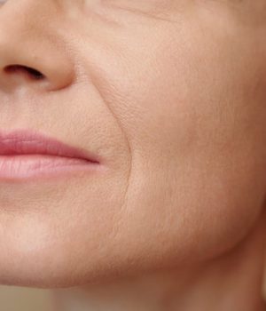 Woman with nasolabial fold concerns