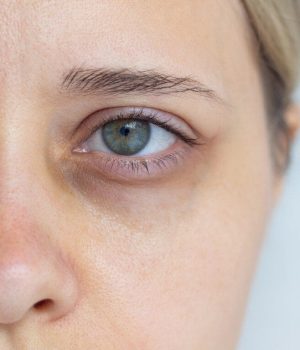 Woman with eye bag concerns