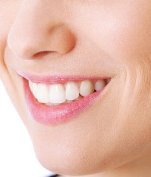 Woman with smile line concerns
